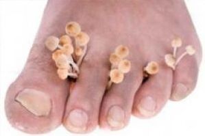 ciuperca unghiilor de la picioare cum se trateazã cu iod